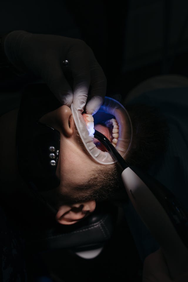 Plomby światłoutwardzalne – ile czasu trwa ich zakładanie?